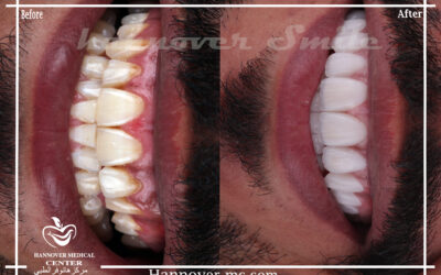 male hollywood smile