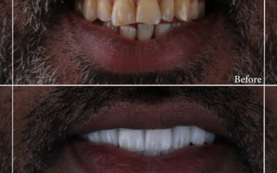 can you eat with snap on smile