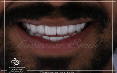 HOW TO GET HOLLYWOOD SMILE