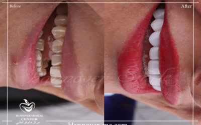 lumineers hollywood smile