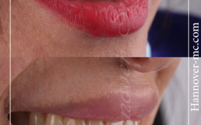 что такое голливудская улыбка