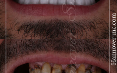 Dental Braces Cost in Dubai