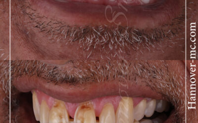 سعر ابتسامة هوليود في دبي 2022 وافضل العيادات