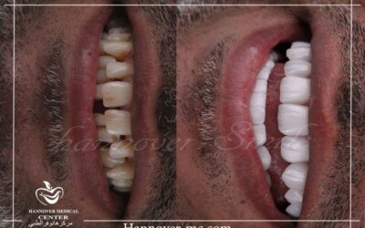 ابتسامة هوليوود بكم