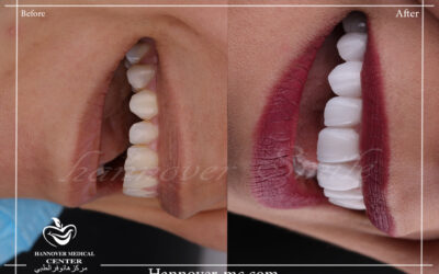 Cosmetic fillings