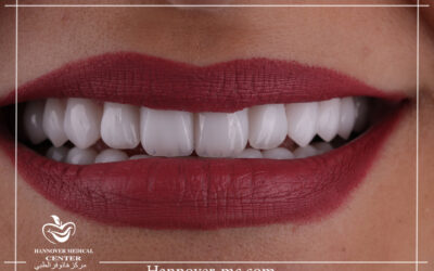 Top 10 Hollywood Smile and Veneers Prices and Offers Sharjah