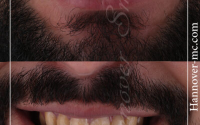 تركيب فينير الشارقة