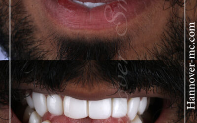 فينير الاسنان الشارقة