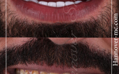 هوليود سمايل 6000 درهم