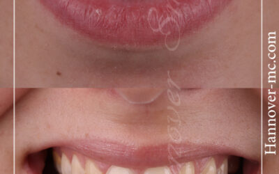 شفط الدهون فى الشارقة