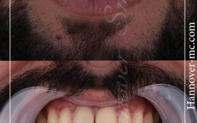 تكلفة ازالة الشعر بالليزر في الامارات