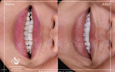 Laser offers in Sharjah