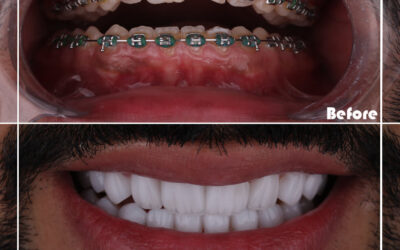 Braces & Aligners