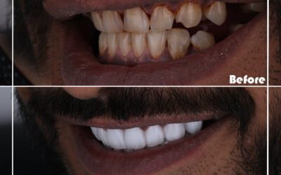 лучшая зубная коронка