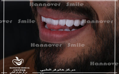 ليزر وجه