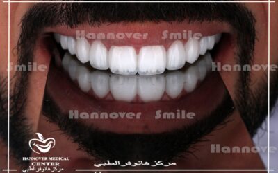 جميع علاجات الاسنان – علاج الابتسامة اللثوية