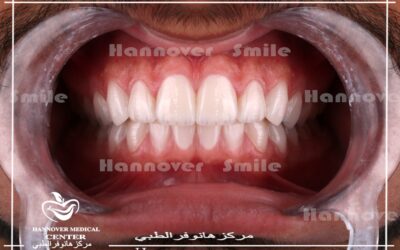 ابتسامة هوليود  – هوليود سمايل