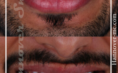 العض على الشفاه أو اللسان