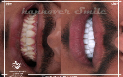 composite veneers vs hollywood smile