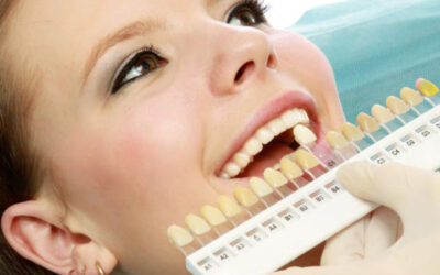 являются ли виниры постоянными зубами