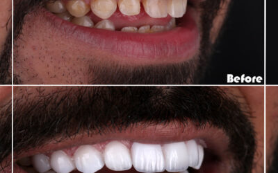 hollywood smile natural