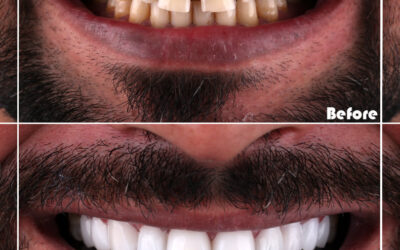 best country for hollywood smile