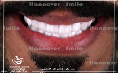 كيف أحكم على ابتسامتي ؟ الإبتسامة الجميلة