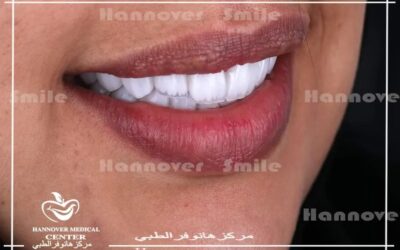 أسعار عمل حشو تجميلي ومميزاته