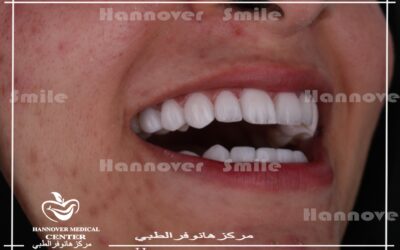 تجميل الاسنان الامامية البارزة