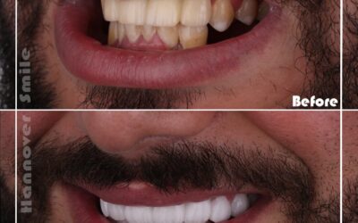 What is the basic dental routine?