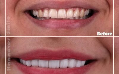 تجميل الاسنان والابتسامة
