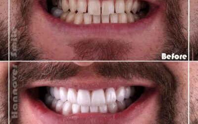 أهم المعلومات التي يجب معرفتها عن ابتسامة هوليود