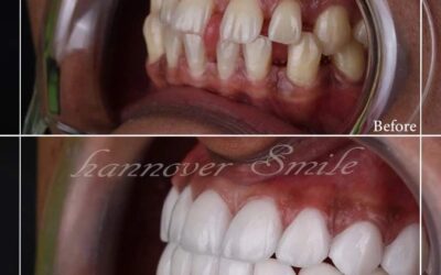 كل شيء عن ابتسامة هوليود فوائدها