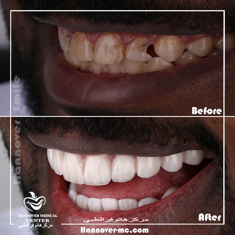 Are veneers permanent? Hannover Medical Center Sharjah