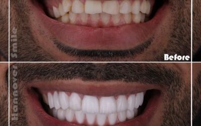 تعرف على اسعار الحشوات التجميلية للاسنان الامامية