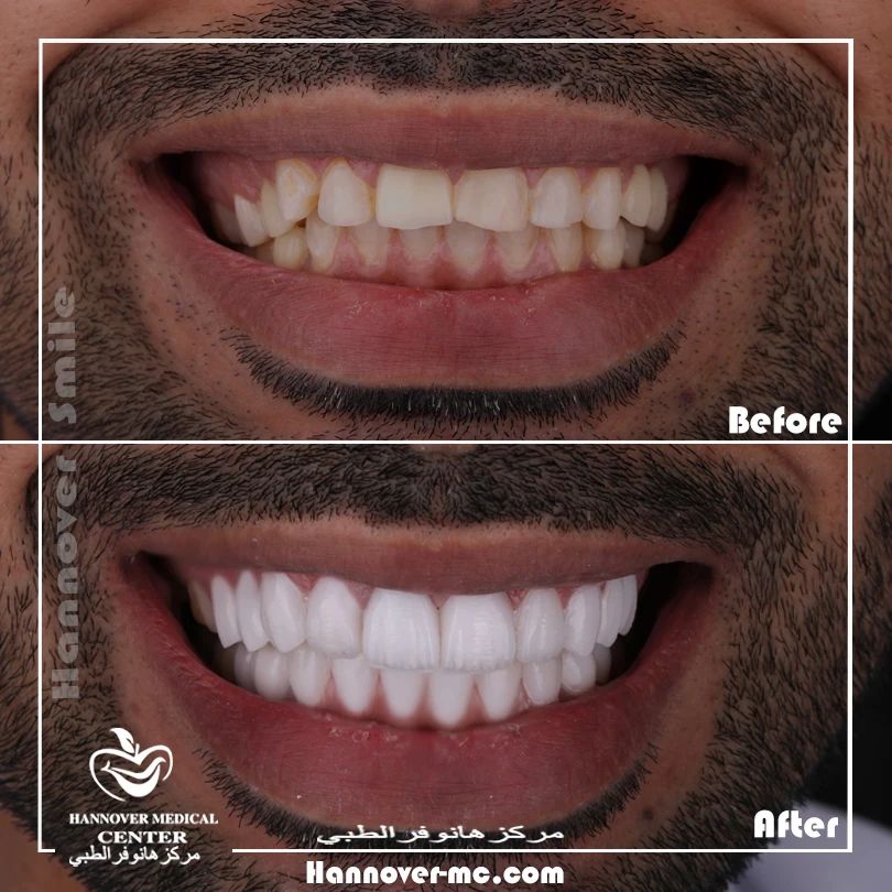 Can salt water make toothache worse? Hannover Medical Center Sharjah