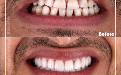 ابتسامة هوليود للرجال