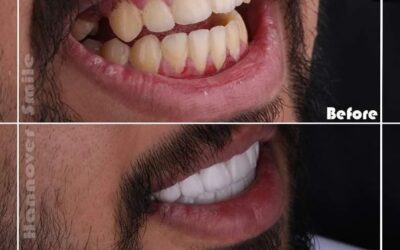 كم سنة تدوم ابتسامة هوليود؟