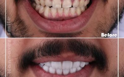 ما الفرق بين ابتسامة هوليود VIP و 3D؟