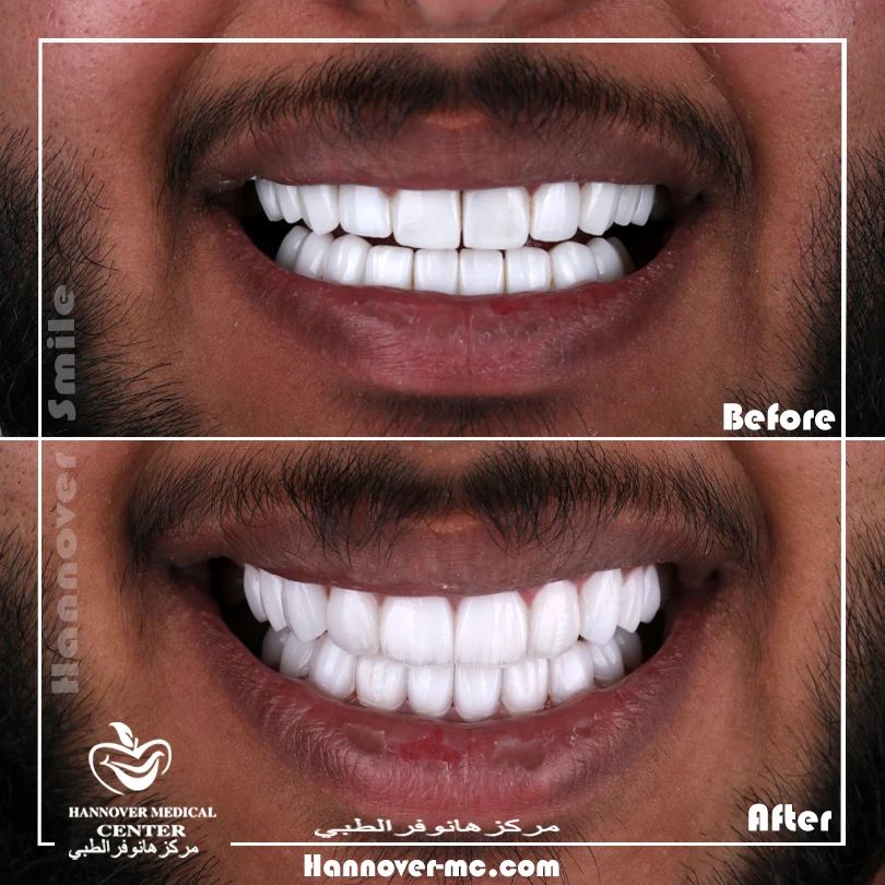 How can I numb my tooth nerve at home? Hannover Medical Center Sharjah