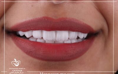 تكلفة ابتسامة هوليود في الإمارات