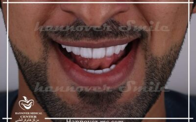 طقم ابتسامة هوليود