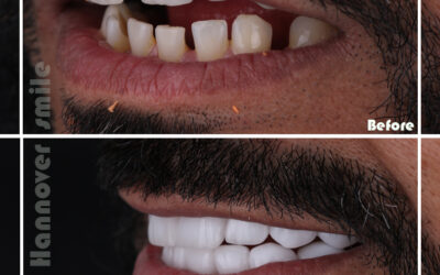 Surgical Tooth Extraction