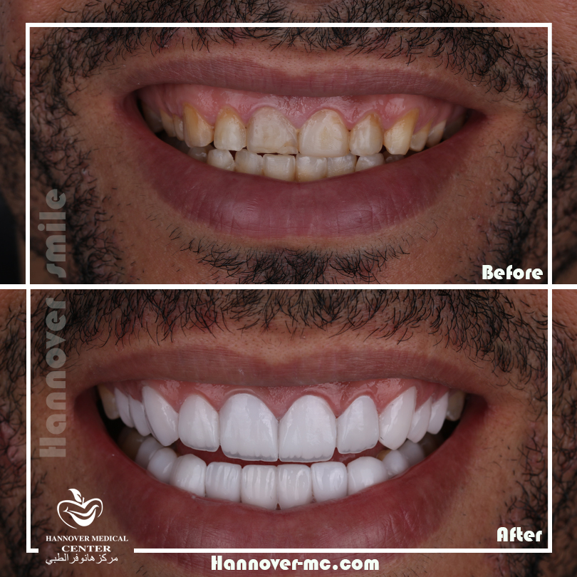 Best dental clinic sharjah for wisdom teeth removal Hannover Medical