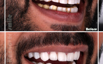 How much veneers per tooth?