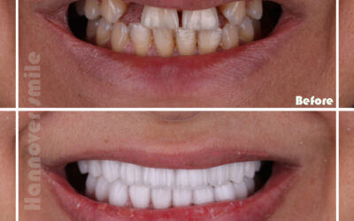 How long will a tooth last after a root canal?