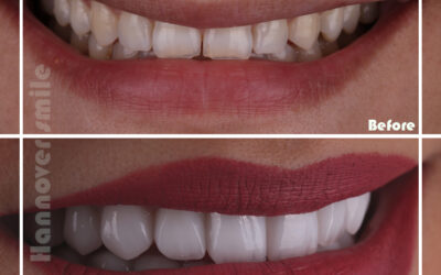 Veneers EMAX | Best Hollywood Smile Makeover in Dubai