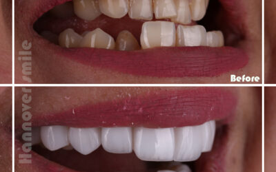 A Teeth Whitening Guide for Your Wedding – Hannover Medical Center