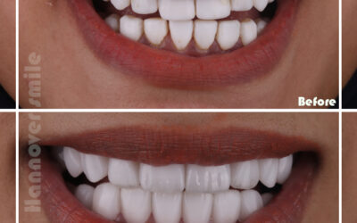 Having a denture, dental implant or bridge made and fitted after losing teeth