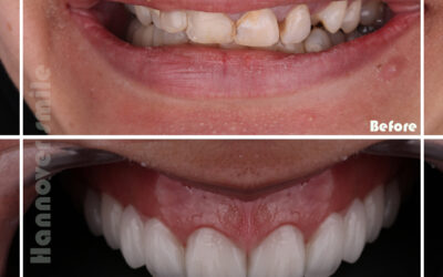 Immediate Tooth Pain Relief for Emergency Dental Care